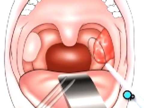 Anses-ouvertes-pour-serre-noeuds-a-amygdales-03-mm-x-12-1