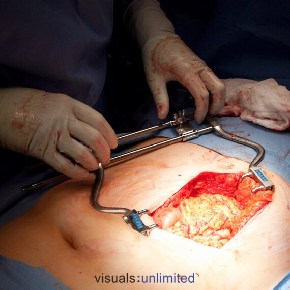 left subcostal incision showing omentum, exposed w/Balfour retractor