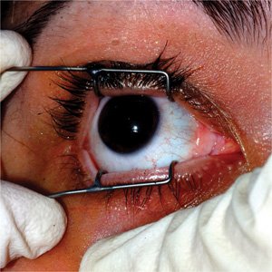 blepharostat-colibri-4-cm