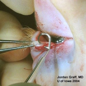 lacrymal_pigtail_probe_1412262399